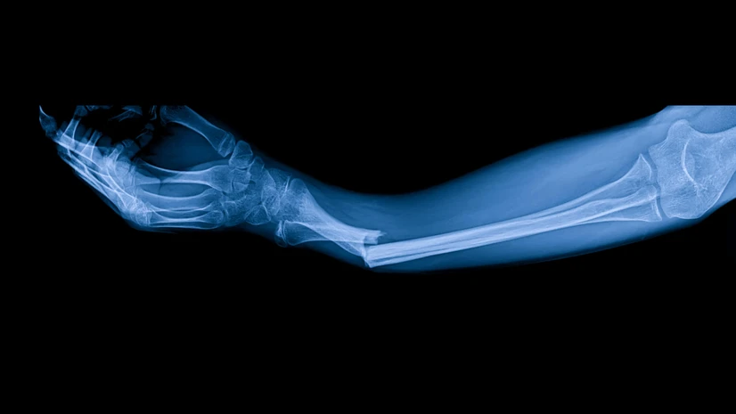 Scientists develop Bone Glue that heals fractures in 3 minutes