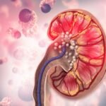 kidney stone