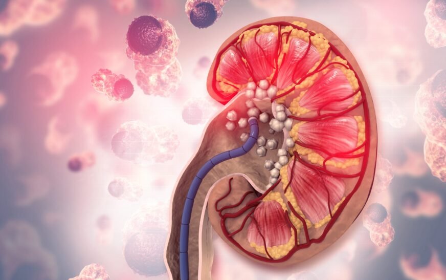 Why are night shift workers at high risk of kidney stones?