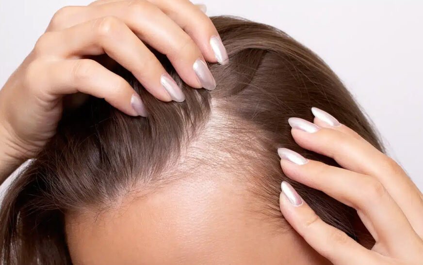 High sugar and processed foods linked to hair thinning, experts say