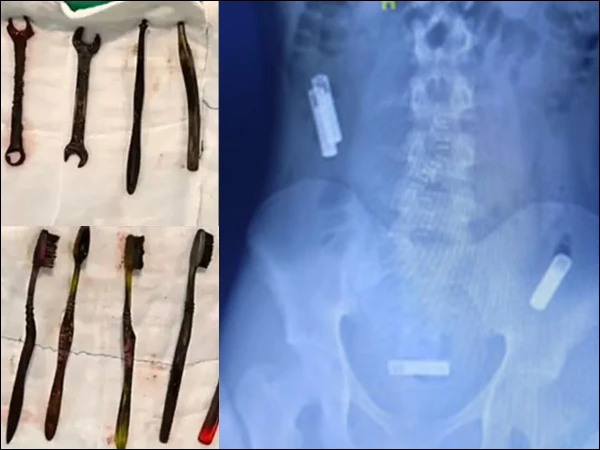 Doctors found tooth brushes