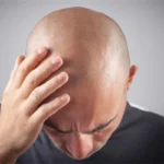 hair loss