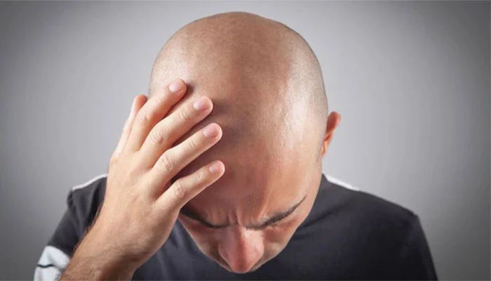 Major cause of hair loss in men revealed: New study makes surprising revelation