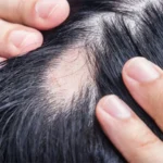 hair loss