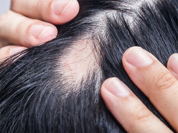 Researchers report possible hair loss risk from weight-loss medications