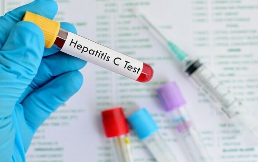 hepatitis C